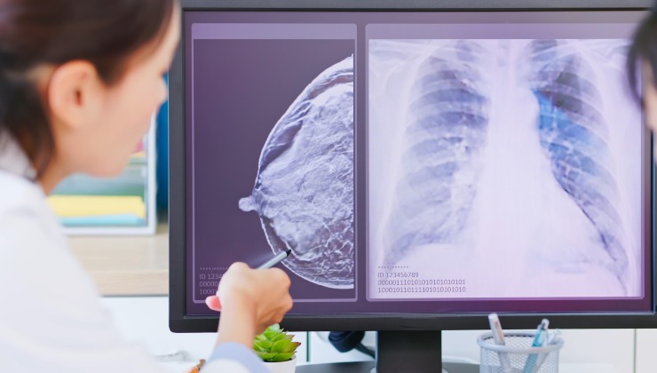 screening tumore polmone 